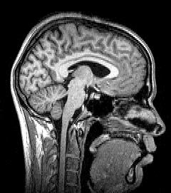 sagittal brain scan black and white